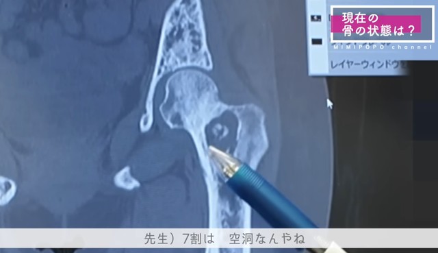 現在もまだ骨は空洞のままのところも…／投稿主さん提供
