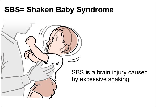 shaken-baby-syndrome-chart-poster-laminated-ubicaciondepersonas-cdmx