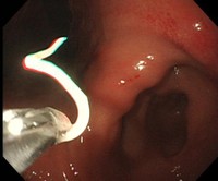 　アニサキスが生体鉗子（かんし）で摘出される瞬間…激しく抵抗しています