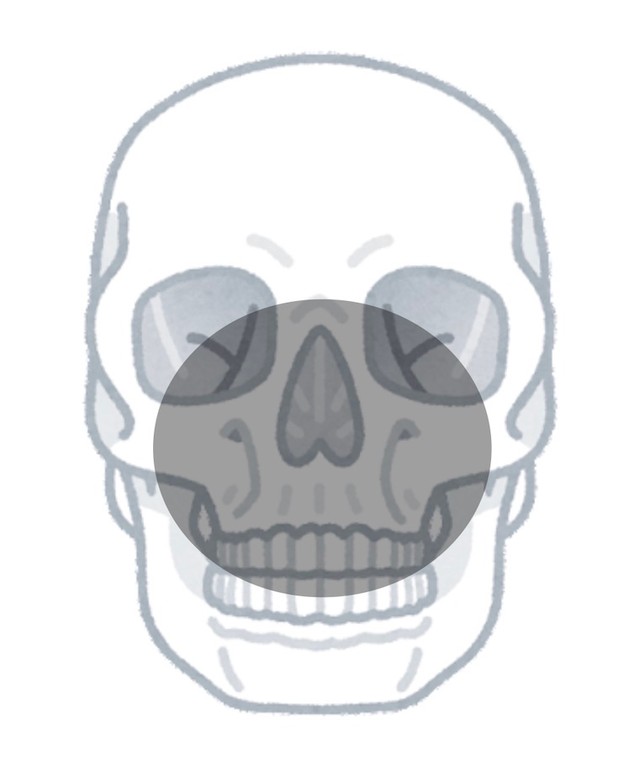 「形成外科が関わる顔面外傷の中でも最悪の類」と言われる「熊外傷」。最も多いのがグレー部分「中顔面」の損傷なのだそう。