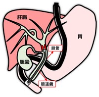 経口胆道鏡のイメージ図　胆道鏡を使用することで胆管内の病変を直接視認することが可能となる