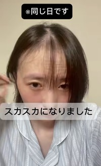 一度の抗がん剤治療でも大量の髪が抜け落ちたそう／うーたんさん提供