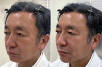 鈴木医師によるヒアルロン酸注入の実例…左が施術前、右が施術後（提供画像）