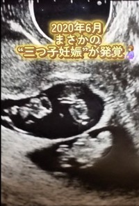 三つ子が発覚した時のエコー写真／あすかさん（@asuka_4kids__)提供