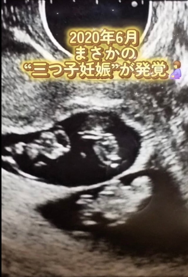 三つ子が発覚した時のエコー写真／あすかさん（@asuka_4kids__)提供