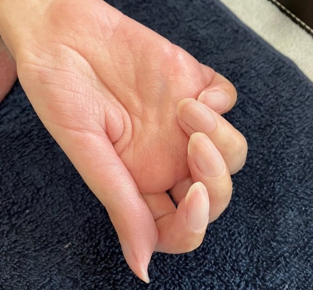自身が動かせるのは右手の指先2本のみ