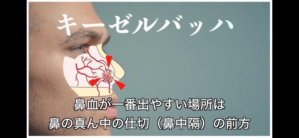 鼻血を止めるには…上向く、ティッシュを詰める→これらは間違い