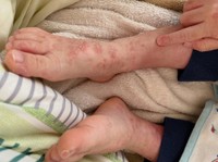 膿疱性乾癬は、うつらない病気