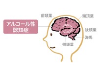 脳が萎縮するアルコール性認知症　症状や回復の可能性を専門医が解説