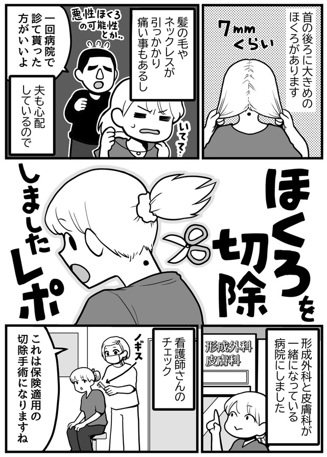 【漫画】『ほくろ切除の手術をしました』1（きくまきさん提供）