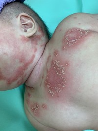 炎症によって、頭皮も耳の中も手のひらも皮膚が剥がれる