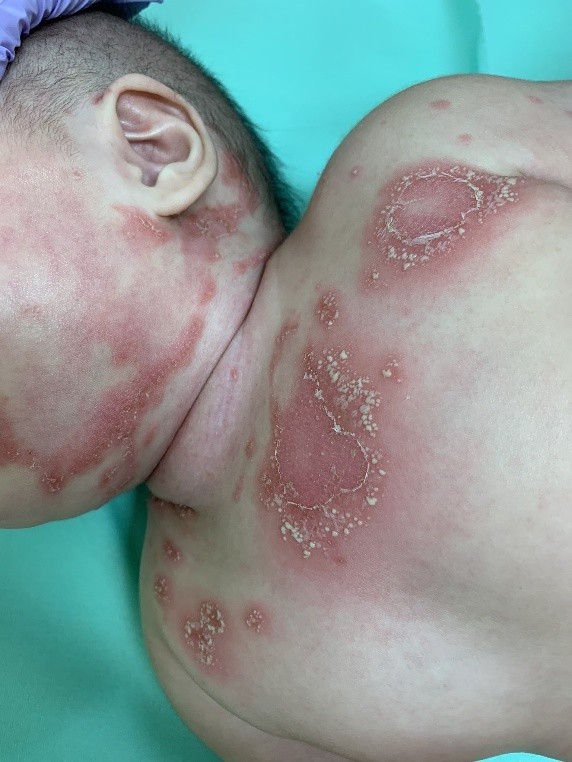 炎症によって、頭皮も耳の中も手のひらも皮膚が剥がれる