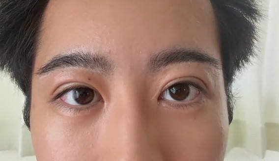 瞼のたるみや厚みを切除する施術後／としきさん（@atarashiifuku）提供