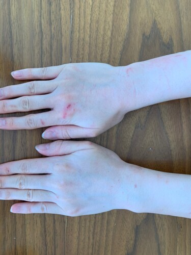 傷だらけのお母さんの手。「これはずいぶん治ってから。ひどいころは写真を撮る余裕もありませんでした」（お母さん提供）