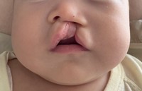 裂け目が鼻まで達する完全口唇裂だった（すいさん提供）
