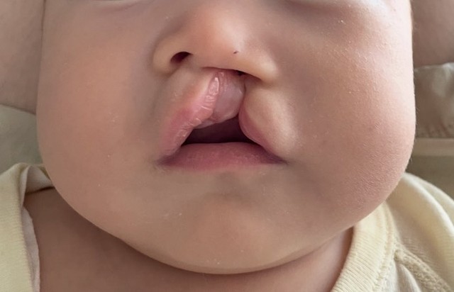 裂け目が鼻まで達する完全口唇裂だった（すいさん提供）