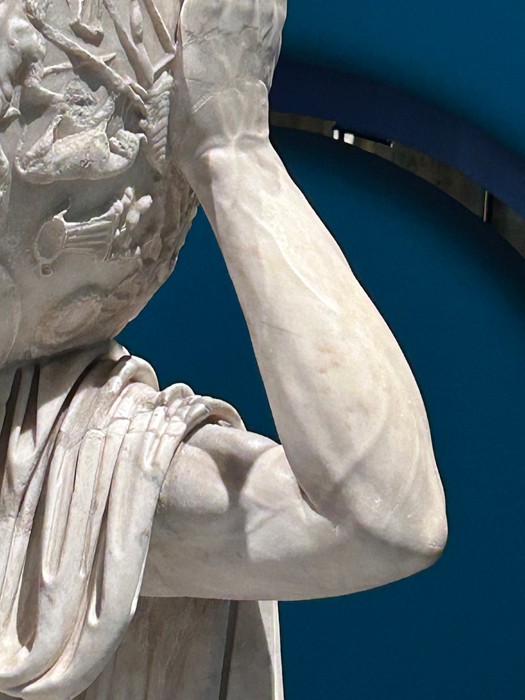 重い天空を支える腕にはたくさんの血管が浮き出ていますが、全部正しいに感動（提供：シャントの医ンフルエンサーさん）