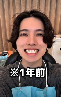 【Before】1年前／歯並び地獄男さん（@akagankochan）提供