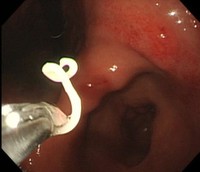 　生体鉗子（かんし）で引き抜かれる際、体を巻きつけて抵抗するアニサキス