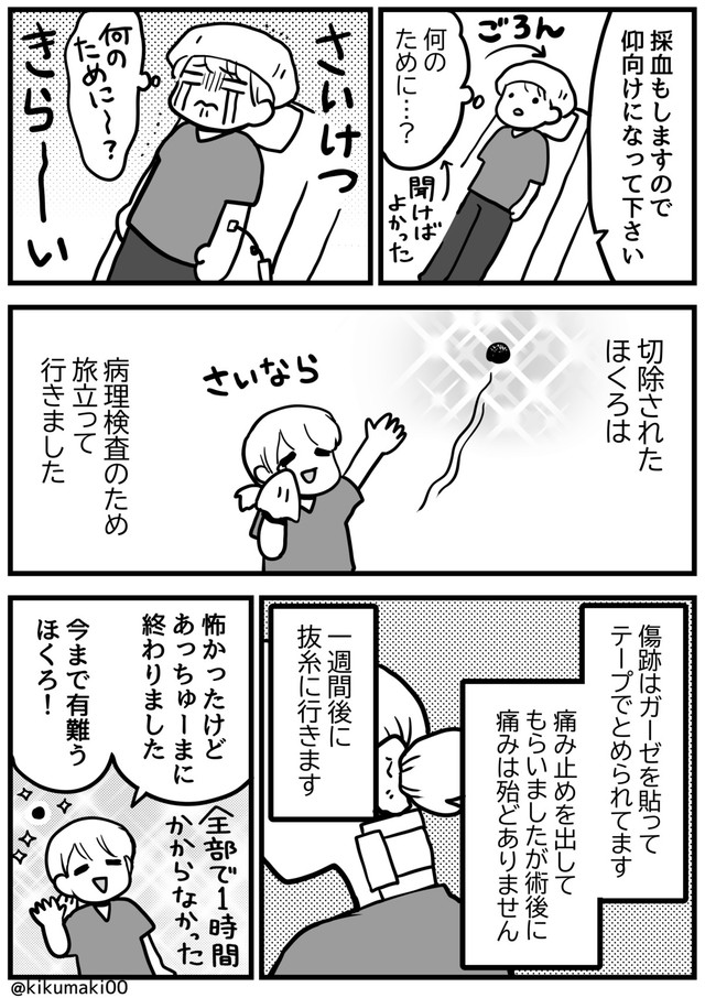 【漫画】『ほくろ切除の手術をしました』7（きくまきさん提供）
