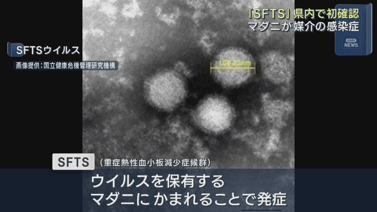 宮城県で初めて重症熱性血小板減少症候群ＳＦＴＳの発生を確認　石巻保健所管内の９０代男性