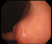 　胃の中にいるアニサキス（中央やや下）