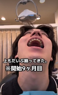 開始9カ月目「上もだいぶそろってきた」／歯並び地獄男さん（@akagankochan）提供