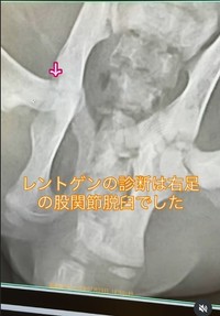 診断は「右股関節脱臼」（コアさん提供、Instagramよりキャプチャ撮影）