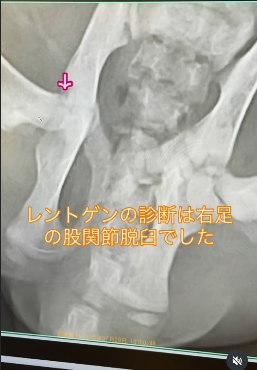 診断は「右股関節脱臼」（コアさん提供、Instagramよりキャプチャ撮影）