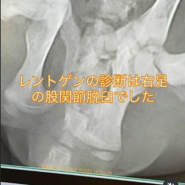 診断は「右股関節脱臼」（コアさん提供、Instagramよりキャプチャ撮影）