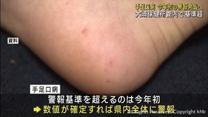 手足口病の感染者　宮城・大崎保健所管内で警報基準を超える５．６７人