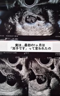 最初の1ヶ月は双子だと言われていたそう／あすかさん（@asuka_4kids__)提供