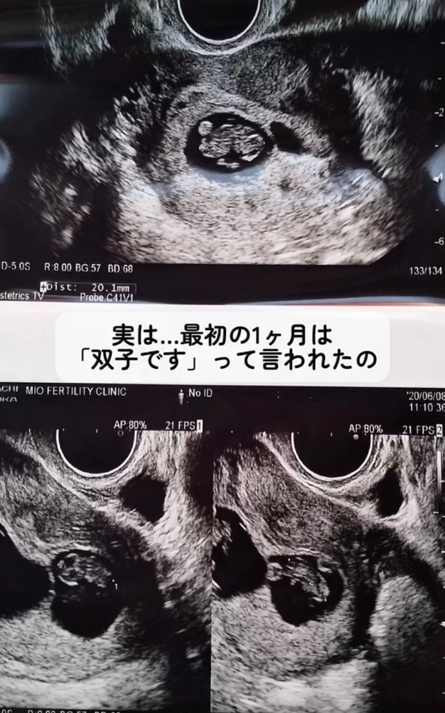 最初の1ヶ月は双子だと言われていたそう／あすかさん（@asuka_4kids__)提供