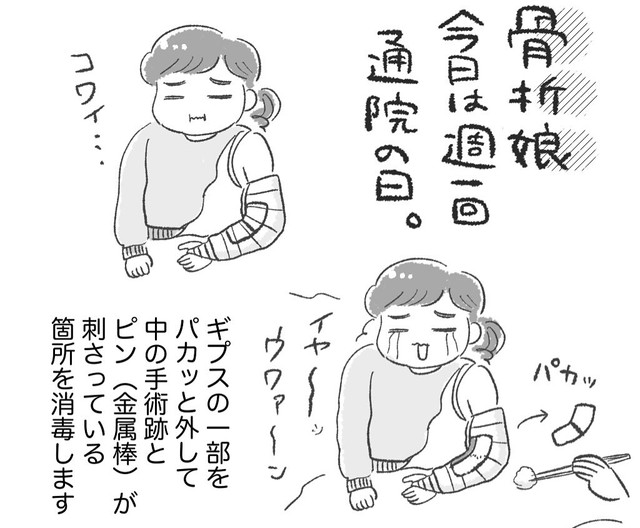 週に一回ギプス内の消毒（柿ノ種まきこさん提供）