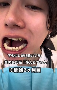 開始2カ月目「下も少しだけ動いてる」／歯並び地獄男さん（@akagankochan）提供