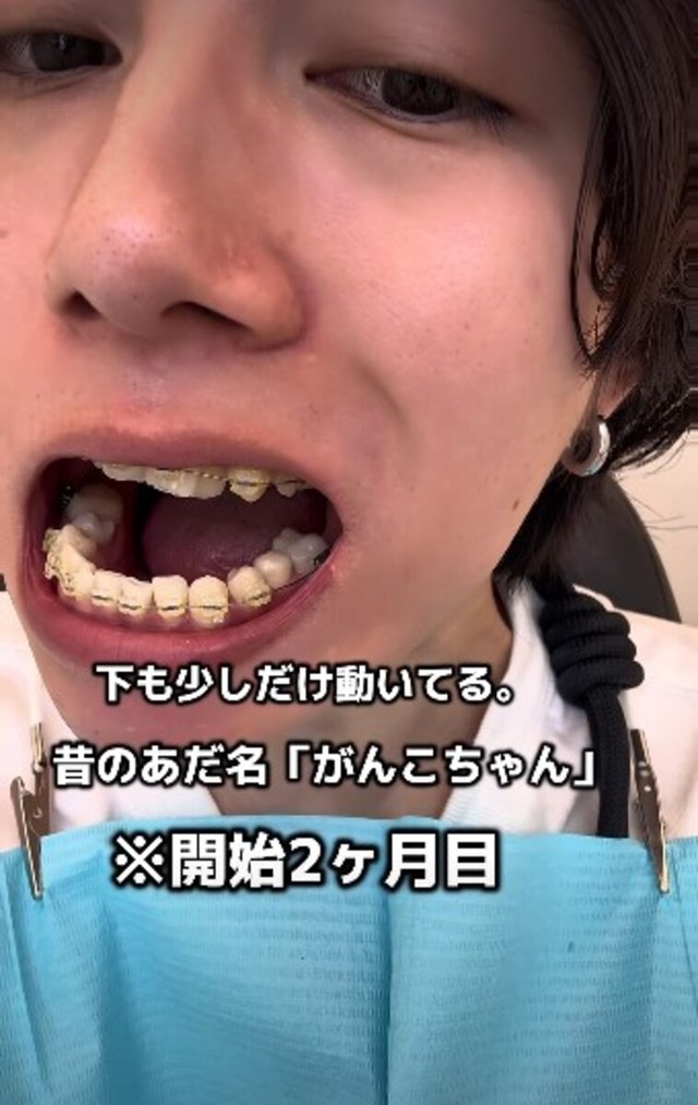 開始2カ月目「下も少しだけ動いてる」／歯並び地獄男さん（@akagankochan）提供
