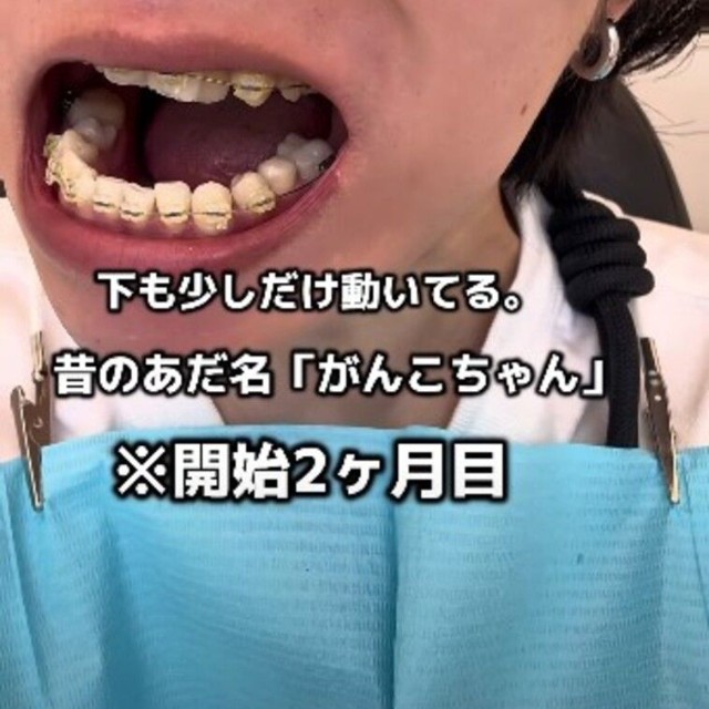 開始2カ月目「下も少しだけ動いてる」／歯並び地獄男さん（@akagankochan）提供