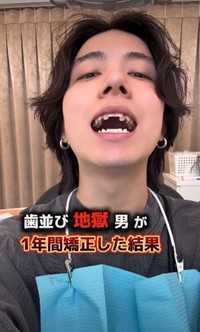 「歯並び地獄男が1年間矯正した結果」／歯並び地獄男さん（@akagankochan）提供