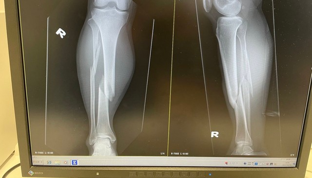 2カ月半に及ぶ入院生活、完治まで7カ月の大怪我となったそう（提供：するさん）