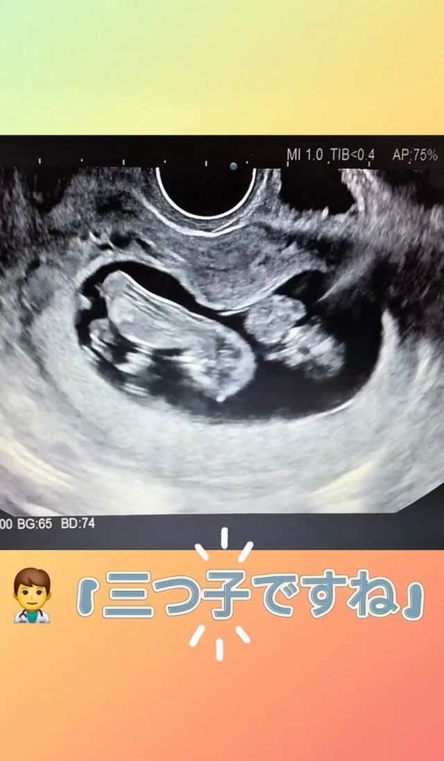 3回目の検診で“三つ子”が発覚／あすかさん（@asuka_4kids__)提供