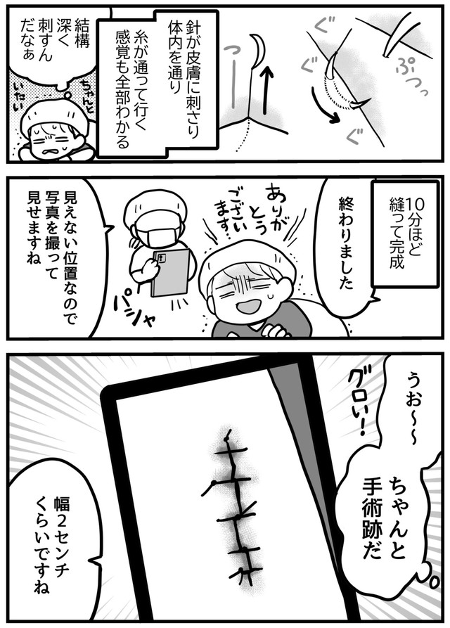 【漫画】『ほくろ切除の手術をしました』6（きくまきさん提供）