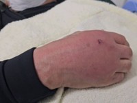 猫をシャンプー中、スタッフが手をかまれ、その手がグローブみたいに腫れ上がり高熱、入院になったという（本田さん提供）