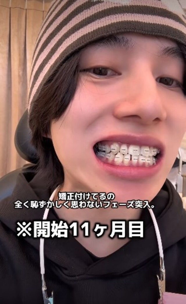 開始11カ月目「矯正付けてるの全く恥ずかしく思わないフェーズ突入」／歯並び地獄男さん（@akagankochan）提供
