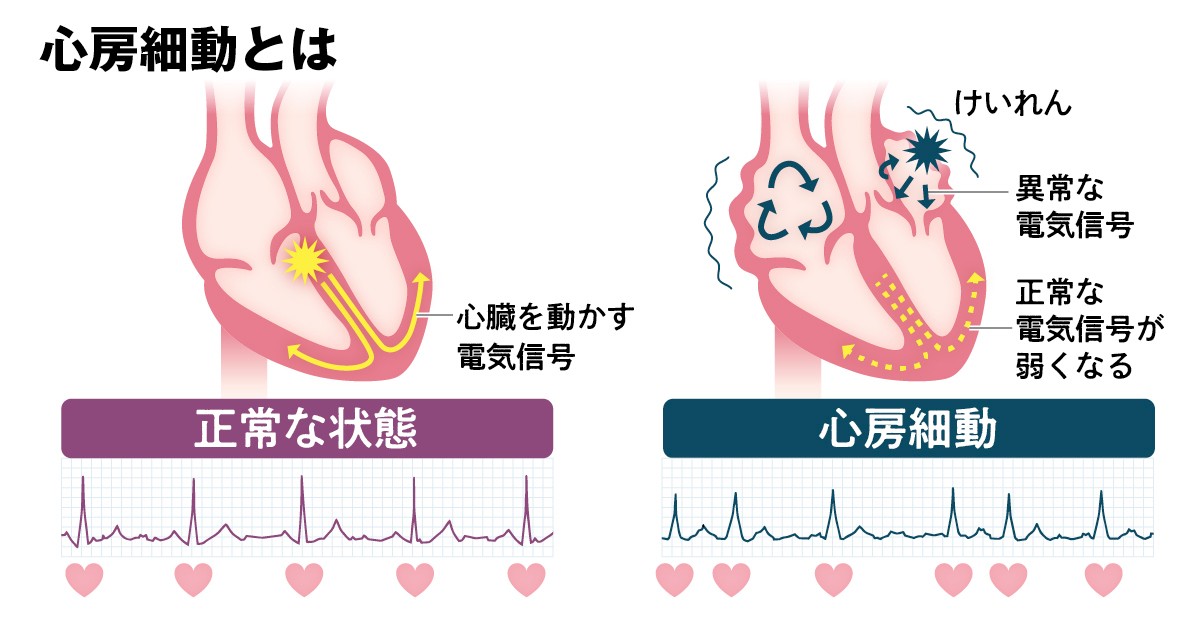 心房細動3