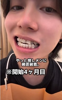 開始4カ月目「推しメンに装置装着」／歯並び地獄男さん（@akagankochan）提供