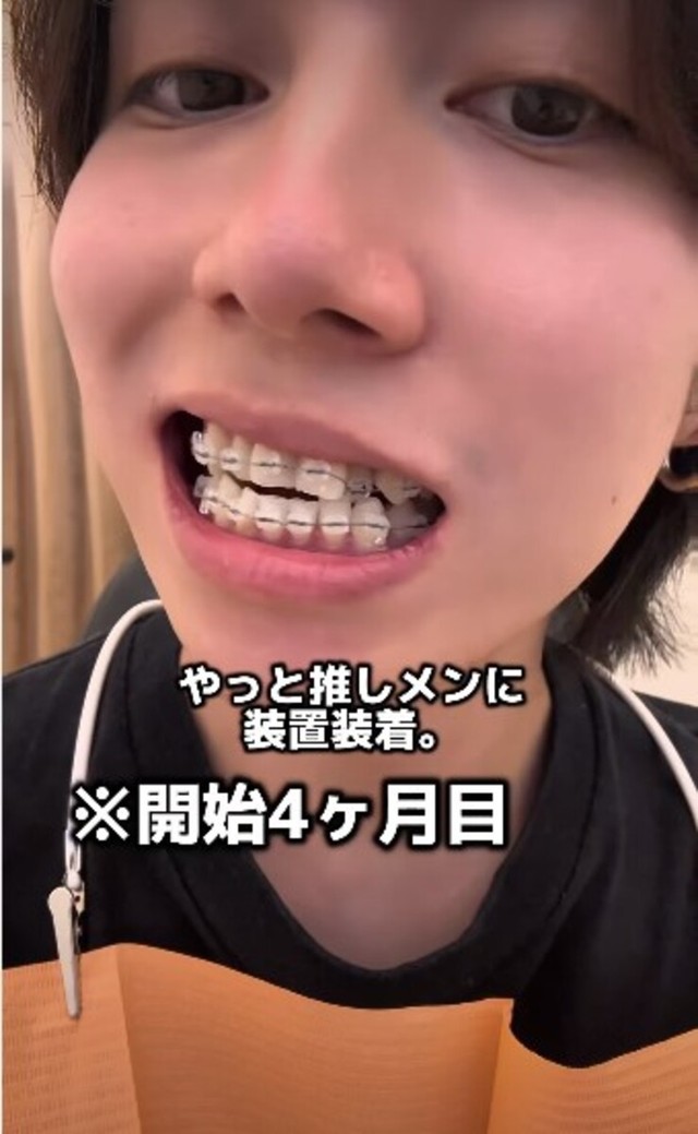 開始4カ月目「推しメンに装置装着」／歯並び地獄男さん（@akagankochan）提供