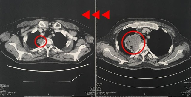 右がオブジーボ投与前、左がオブジーボ投与後（小西さん提供のＣＴ画像）