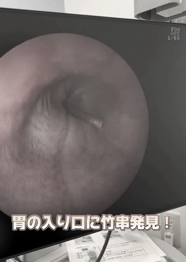 胃の入口に竹串を発見！（稲野辺院長提供、Instagramよりキャプチャ撮影）
