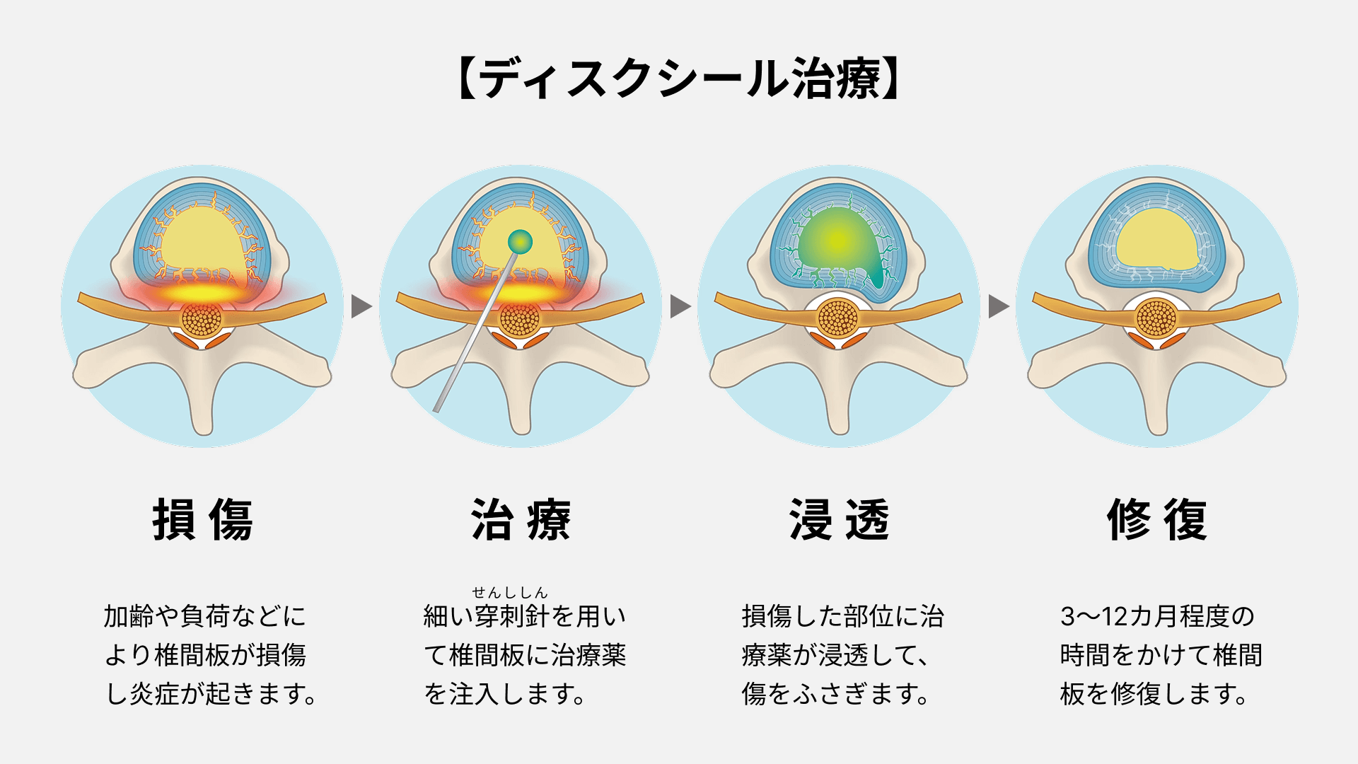 ディスクシール治療説明図