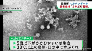 夏風邪の一種ヘルパンギーナ患者が急増　宮城県が警報を出し感染予防徹底を呼び掛け